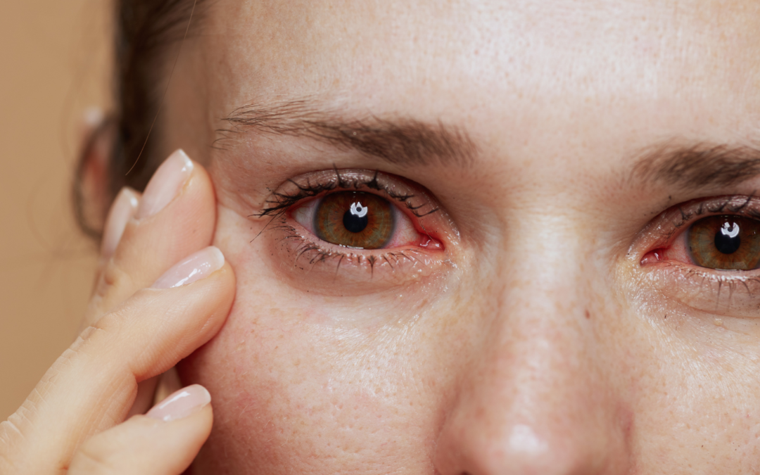 Dry Eyes: A Common Menopause Problem